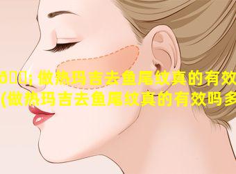 🐡 做热玛吉去鱼尾纹真的有效吗(做热玛吉去鱼尾纹真的有效吗多少钱)